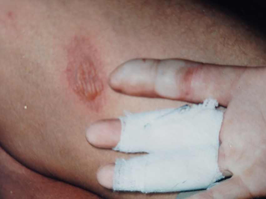 Damean Ross's burns and blisters from a couple of drops of glyphosate on his hands and thighs.